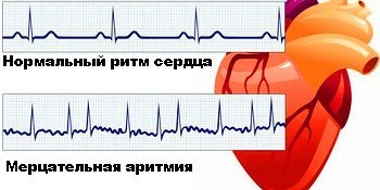 Лечится ли аритмия сердца