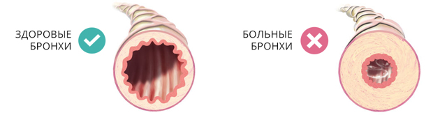 Какие существуют болезни легких