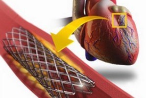 Осложнения после стентирования сосудов сердца и коронарных артерий - компания Стентоник