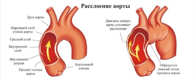 Расслоение аорты — Симптом Инфо