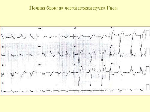 Блокады сердца на экг - Всё о сердце