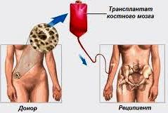 Пересадка костного мозга при лейкозе, можно ли вылечиться, прогноз