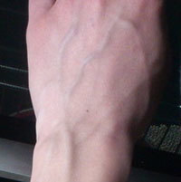 Почему видны вены на руках и как их убрать?