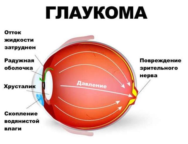 Почему лопаются сосуды в глазах? Причины и лечение
