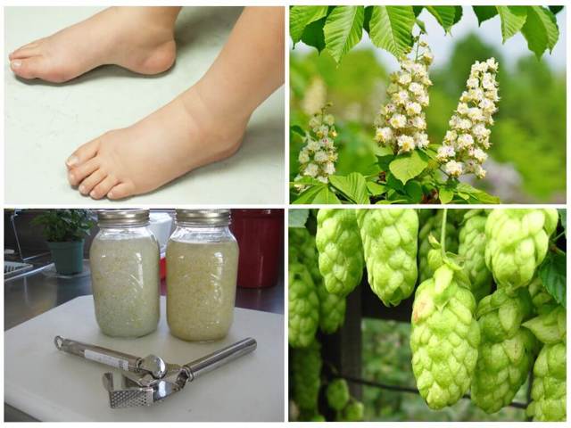 Отеки при варикозе - снимаем быстро и надолго