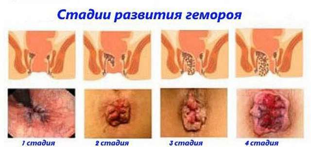 Геморрой - причины, симптомы, диагностика и лечение