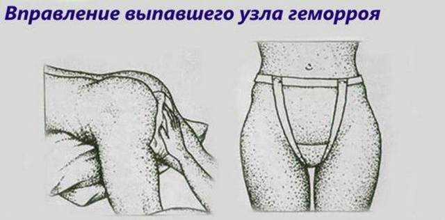 Выпал геморроидальный узел