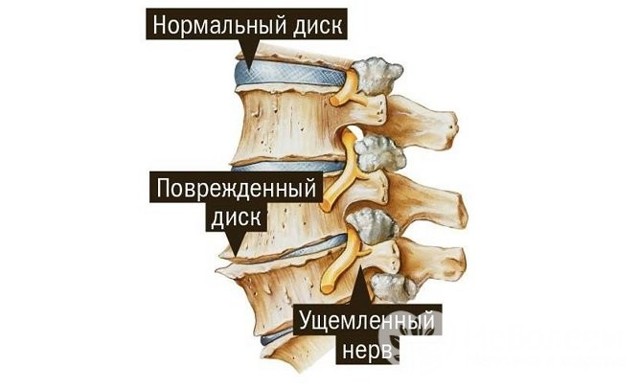 Остеохондроз грудной клетки