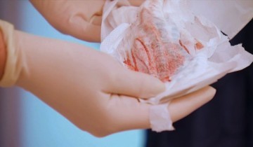 Главные отличия имплантационного кровотечения от месячных