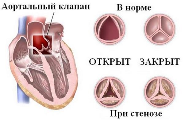 Боли в области сердца при различных заболеваниях - причины, характер, лечение