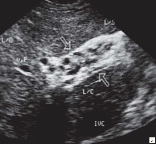 Билиарная гипертензия печени: симптомы, признаки на УЗИ и лечение синдрома