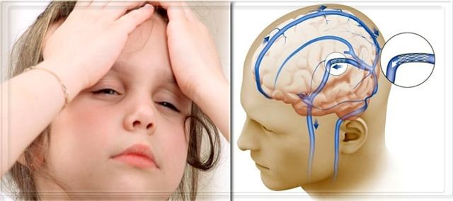 Внутричерепное давление – причины, симптомы и признаки (у взрослого, у ребенка), диагностика, методы лечения. Как измерить? Как снизить повышенное внутричерепное давление?