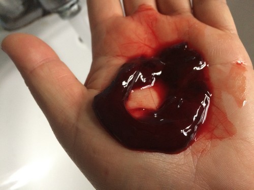 Месячные идут со сгустками крови и кусками — причины