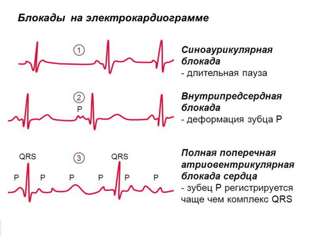 Блокада сердца 2 степени лечение