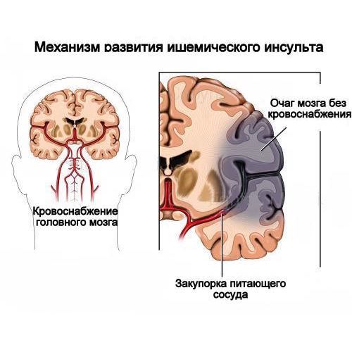 Ишемический инсульт - причины, симптомы, диагностика и лечение