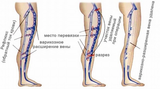 Удалили вены на ноге как ухаживать. Послеоперационный период после удаления вен на ног должен быть именно таким.