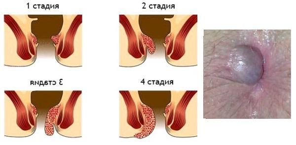 Зуд в заднем проходе у женщин: причины появления, лечение