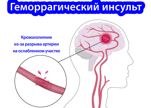 Сколько живут после инсульта - как жить после инсульта?
