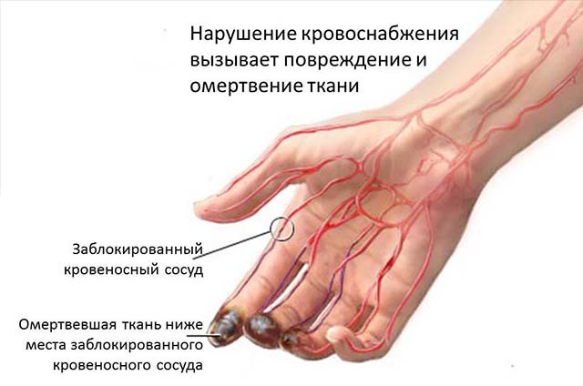Опухла вена на пальце руки