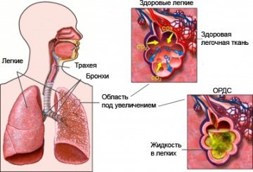 Отек легких симптомы неотложная помощь