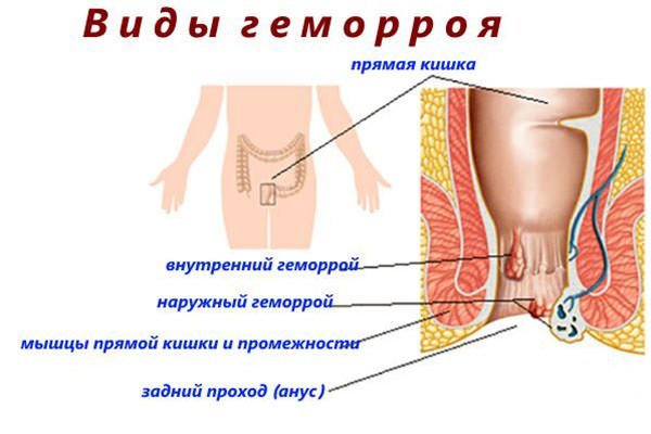 Свечи от геморроя релиф: 3 вида препарата, инструкция и стоимость
