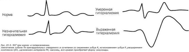 Симптомы гиперкалиемии: у взрослых и детей, лечение заболевания