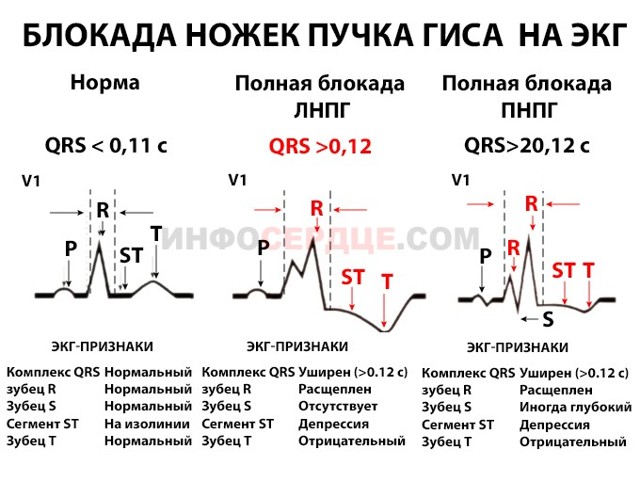 Неполная блокада левой ножки пучка Гиса - причины, лечение
