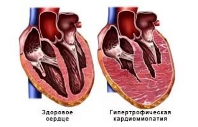 Гипертрофическая кардиомиопатия.