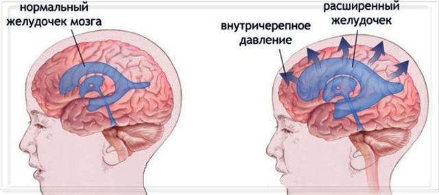 Внутричерепное давление – причины, симптомы и признаки (у взрослого, у ребенка), диагностика, методы лечения. Как измерить? Как снизить повышенное внутричерепное давление?