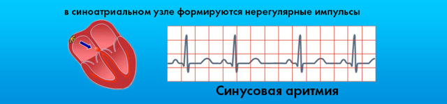 Картинки ЭКГ при нарушениях ритма