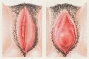 Вульвит у женщин – симптомы и лечение, фото