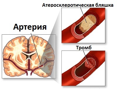 Транзиторная ишемическая атака - за шаг до инсульта.