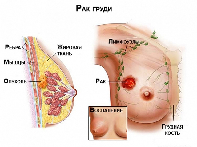 Боль в правой груди: что это может означать