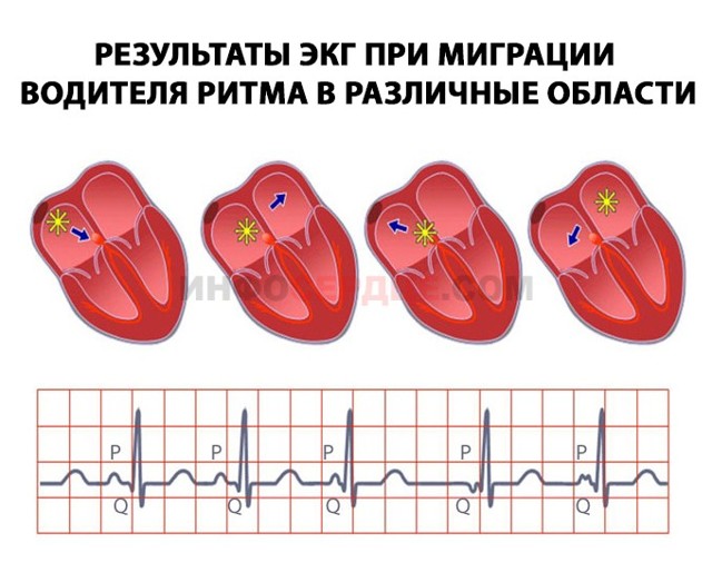 Миграция водителя ритма по предсердиям: что это такое, симптомы и лечение