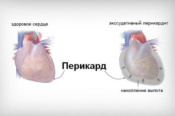 Хронический перикардит, симптомы хронического перикардита