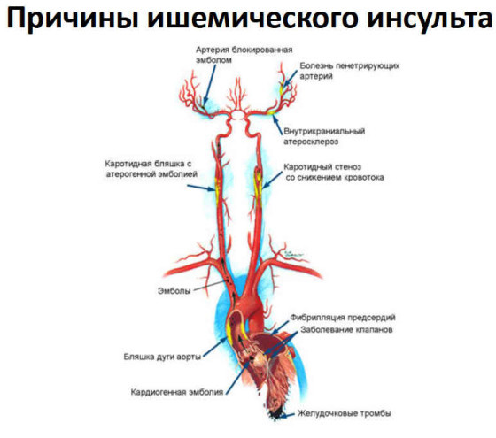 Ишемическая болезнь сердца - причины, симптомы, лечение