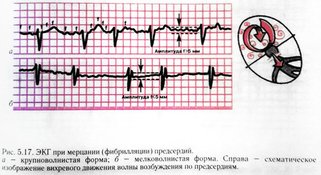 Мерцательная аритмия: причины, симптомы и лечение