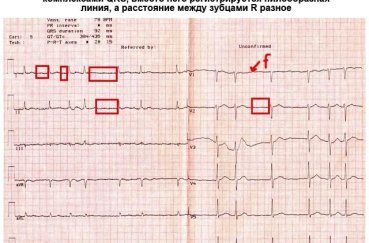 Расшифровка ЭКГ — норма и отклонения, выявление патологий