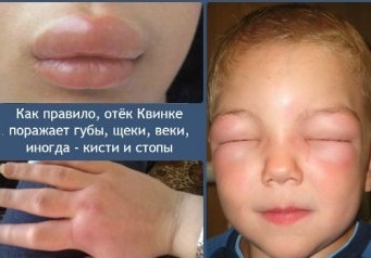 Ангионевротический отек (или отек Квинке): фото, лечение