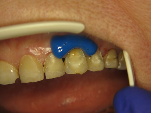 Пришеечный кариес - причины, симптомы, диагностика и лечение