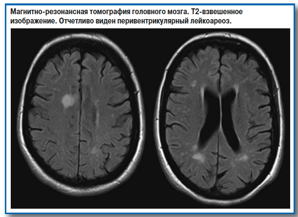 Единичные очаги в белом веществе головного мозга - результаты МРТ