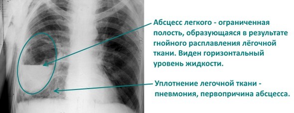 Гнойные заболевания легких. Острый абсцесс легкого