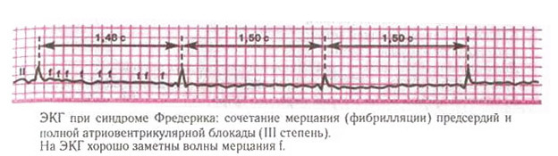 Что такое синдром Фредерика: суть, симптомы и лечение патологии. Синдром фредерика: что это, признаки, на экг, лечение