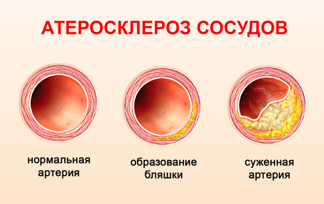 Аритмия сердца: симптомы, причины, лечение
