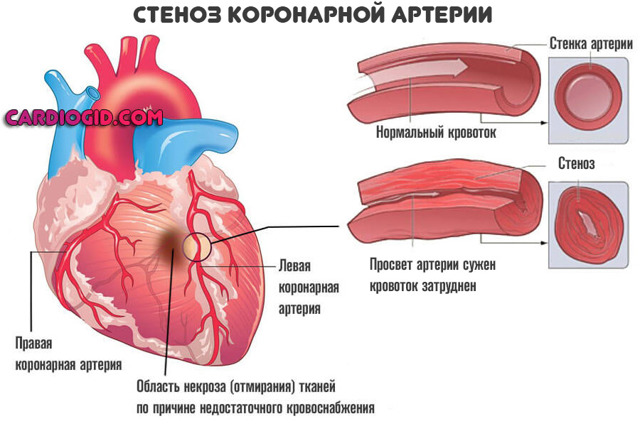 УКРЕПЛЕНИЕ СЕРДЕЧНОЙ МЫШЦЫ. СЕРДЦЕ ПИТАНИЕ ПРОФИЛАКТИКА ПРОДУКТЫ СРЕДСТВА ВИТАМИНЫ