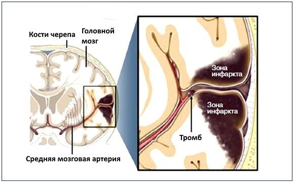 Сопор и кома при инсульте - Инсульт . Реабилитация