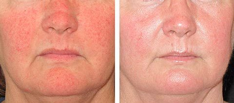 Как убрать красные сосуды на лице в домашних условиях