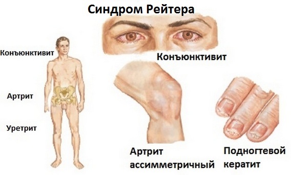 Хламидиоз: у мужчин, женщин; фото, симптомы и лечение