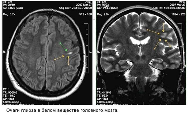Единичные очаги в белом веществе головного мозга - результаты МРТ