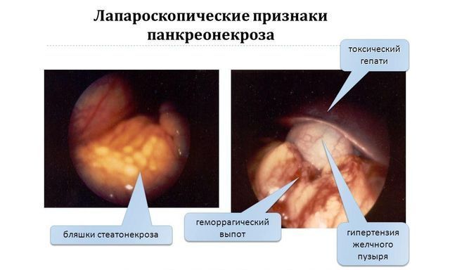 Что такое геморрагический панкреонекроз